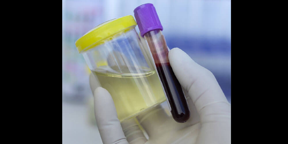 Kiểm tra doping bằng cách xét nghiệm máu và nước tiểu